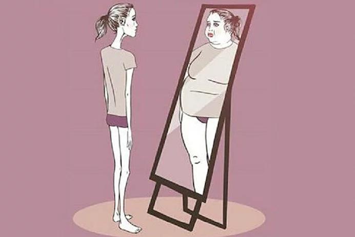 Anorexia Nervosa