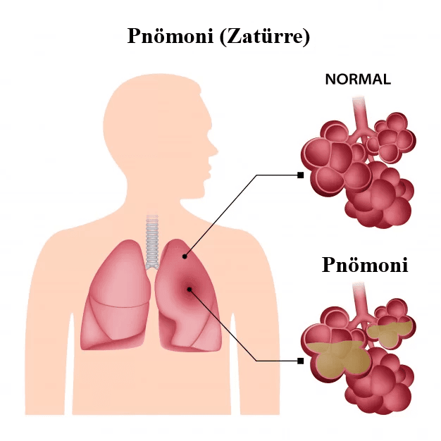 Pneumonia (Lobar Pneumonia)