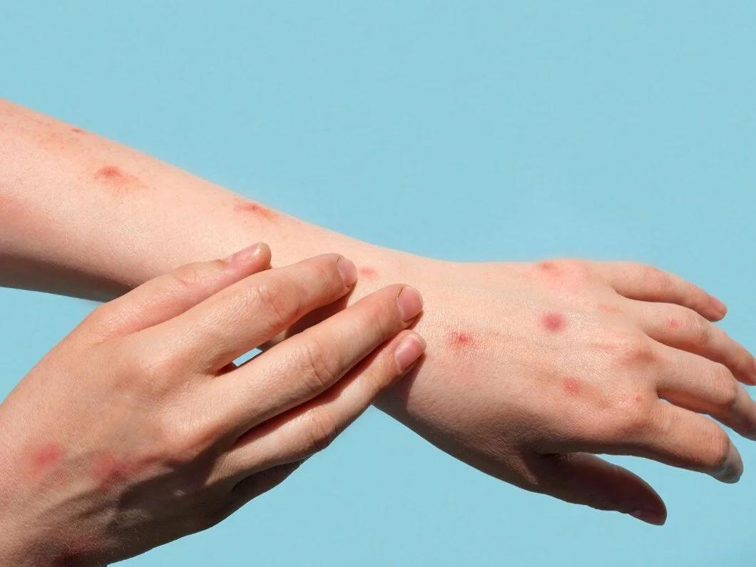 Eradication of Smallpox
