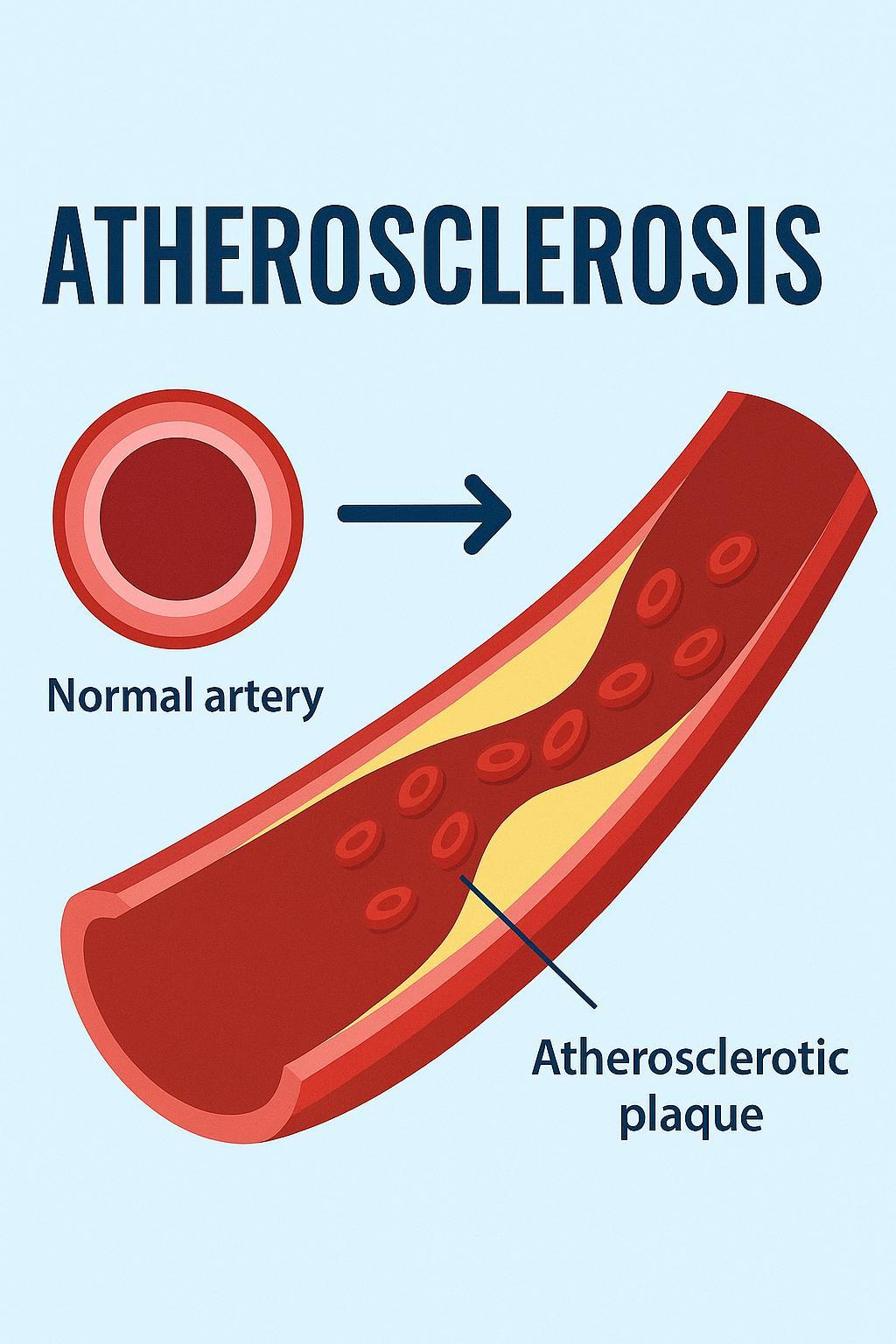 Atherosclerosis