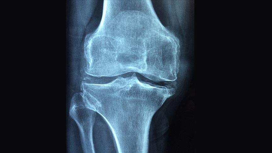 Osteoporosis