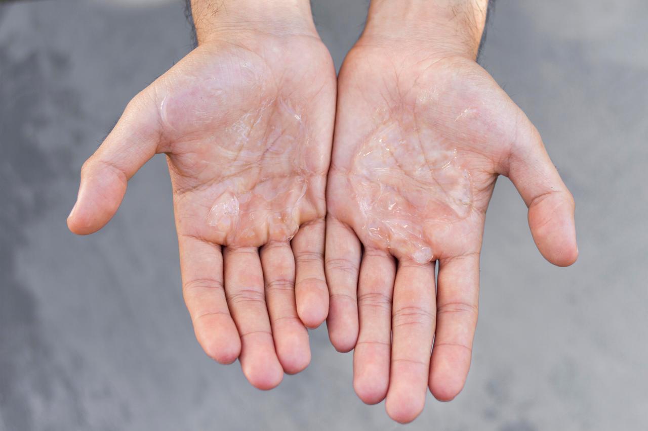 Leprosy Cases Detected in Croatia and Romania (December 2025)