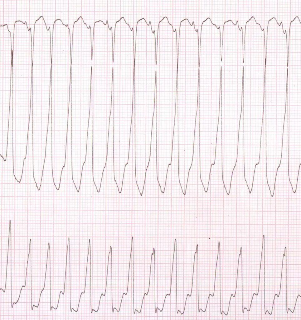 Ventricular-Tachycardia-ECG-965x1024.jpg